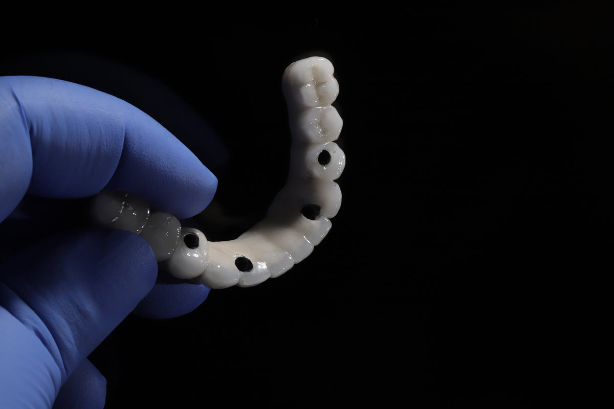 The All-on-4, All-on-X, and All-on-4 treatment concepts in dental implant therapy provide full arch dental prosthesis for completely edentulous jaws. Dental implants are a dentistry treatment placed