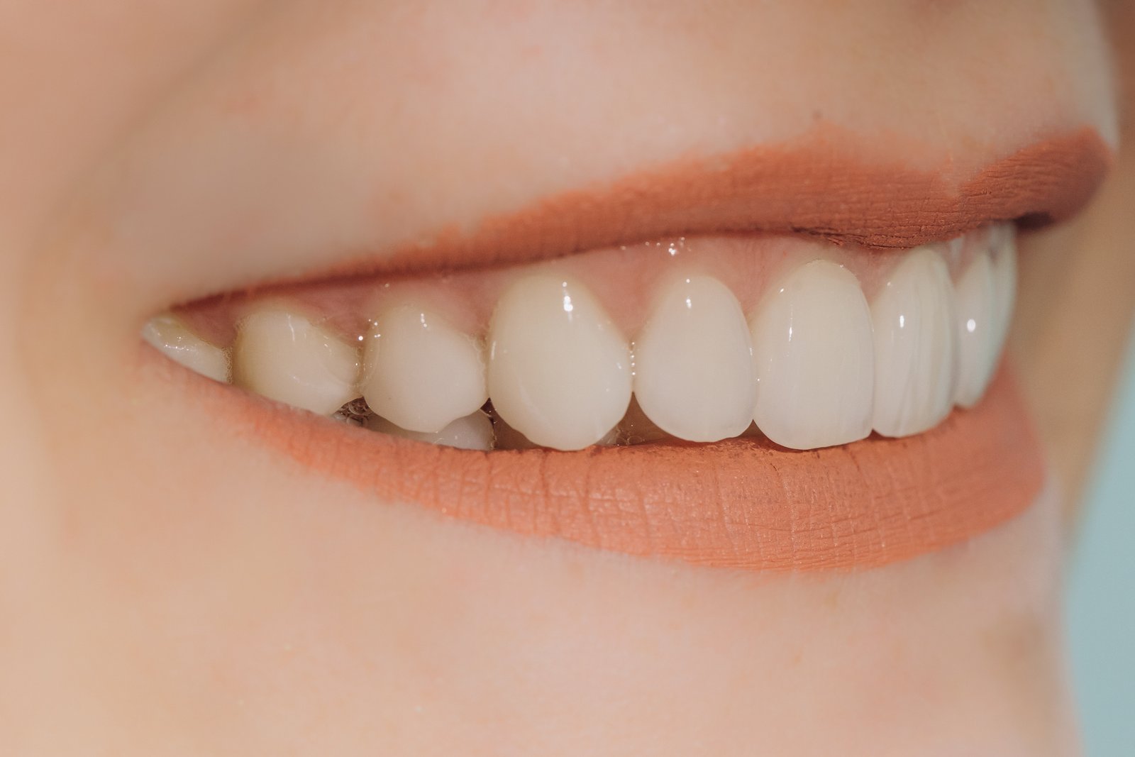 Hollywood smile with porcelain crowns and veneers, illustrating how veneers can address multiple cosmetic dental concerns at once
